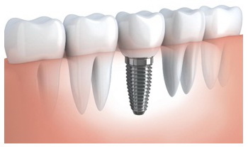Конструкция зубного импланта